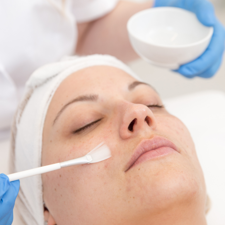 Chemical Peel microneedling facial
